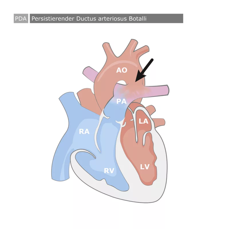 Persistierender Ductus arteriosus Botalli PDA